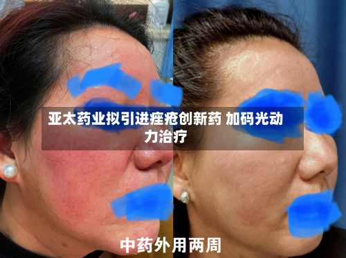 亚太药业拟引进痤疮创新药 加码光动力治疗-第2张图片